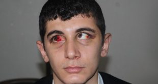 Kızarmış ve morarmış bir gözün yakın çekim portresi